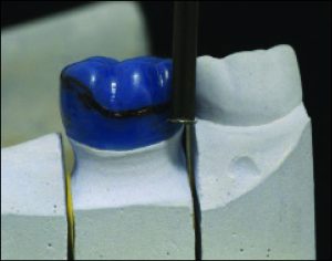 Figure 10-54. Using a 0.25 mm undercut gauge suitable for the planned Akers clasp on the crown, an adequate undercut is created on the distobuccal surface of the wax pattern.