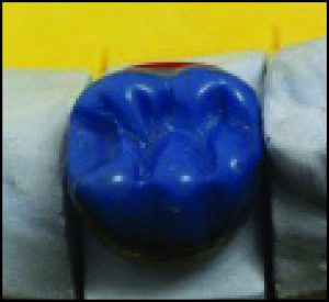 Figure 10-56. The final shape of the rest seat on the wax pattern is refined using a round-ended hand instrument.