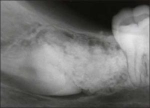 Figure 10-6. Complex odontoma located in the eruption path of an impacted third molar, obstructing its eruption.
