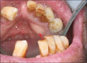 Figure 10-7. Lingual tori