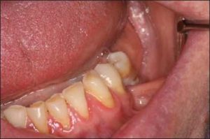 Figure 10-9. Muscle attachment with altered position due to ridge resorption.