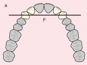 Figure 11.10. a) Cl I Mod 1: The diametric fulcrum axis passing through the terminal abutments 13 and 23.