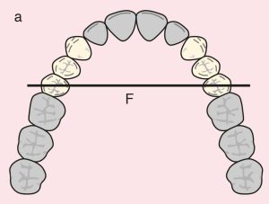 Figure 11.11. a) Cl I Mod 1: The diametric fulcrum axis passing through the terminal abutments 15 and 25.