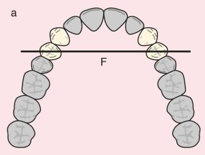 Figure 11.12. a) Cl I Mod 1: The diametric fulcrum axis passing through the terminal abutments 14 and 24.