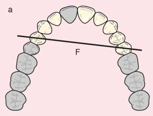 Figure 11.13. a) Cl I Mod 1: The diagonal fulcrum axis passing through the terminal abutments 14 and 25.