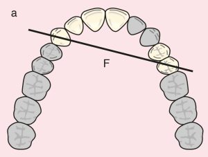 Şekil 11.14. a) Cl I Mod 1: The diagonal fulcrum axis passing through the terminal abutments 13 and 25.