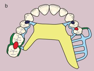 Figure 11.16. b) Metal framework design.