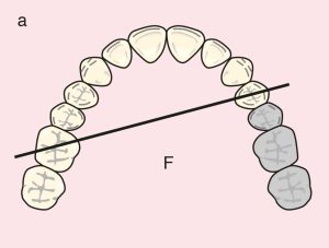 Figure 11.17. a) Class II: Diagonal fulcrum line passing through the terminal abutments of teeth 24 and 16.