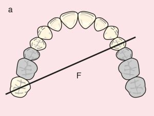 Figure 11.19. a) Class II Mod 1: Diagonal fulcrum line passing through the terminal abutments of teeth 24 and 17.