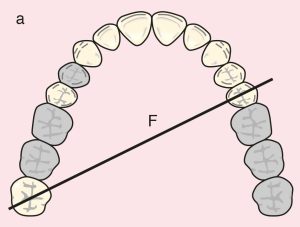 Figure 11.20. a) Cl II Mod 2: Diagonal fulcrum line passing through the terminal abutments of teeth 25 and 18.