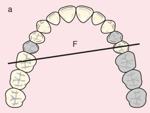Figure 11.21. a) Cl II Mod 2: Diagonal fulcrum line passing through the terminal abutments of teeth 25 and 16.