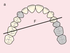 Figure 11.22. a) Cl II Mod 1: Diagonal fulcrum line passing through the terminal abutments of teeth 24 and 16.