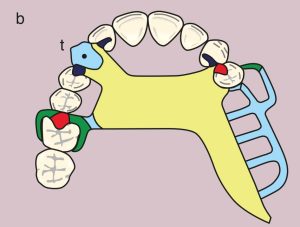 Figure 11.22. b) Metal framework design.