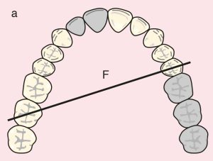 Figure 11.23. a) Cl II Mod 1: Diagonal fulcrum line passing through the terminal abutments of teeth 25 and 17.