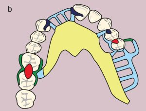 Figure 11.23. b) Metal framework design.