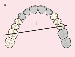 Figure 11.24. a) Cl II Mod 1: Diagonal fulcrum line passing through the terminal abutments of teeth 25 and 16.