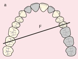 Figure 11.25. a) Cl II Mod 2: Diagonal fulcrum line passing through the terminal abutments of teeth 25 and 17.