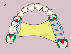 Figure 11.26. b) Metal framework design.