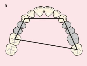 Figure 11.27. a) Class III Mod 1: Quadrilateral support plane formed by the terminal abutments of teeth 23, 27, 13, and 16.