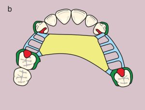 Figure 11.27. b) Metal framework design.