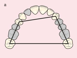 Figure 11.28. a) Cl III Mod 2: Quadrilateral support plane formed by the terminal abutments of teeth 23, 27, 14, and 17.