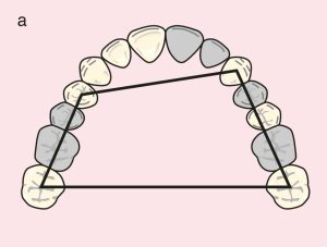 Figure 11.29. a) Cl III Mod 3: Quadrilateral support plane formed by the terminal abutments of teeth 23, 27, 14, and 17.