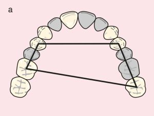 Figure 11.30. a) Cl III Mod 3: Quadrilateral support plane formed by the terminal abutments of teeth 24, 27, 14, and 16.