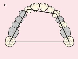 Figure 11.31. a) Cl III Mod 2: Quadrilateral support plane formed by the terminal abutments of teeth 23, 27, 12, and 17.