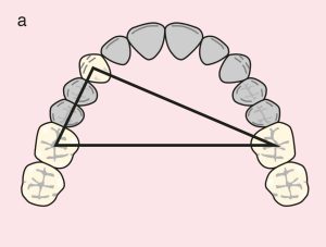 Figure 11.32. a) Cl III Mod 1: Triangular support plane formed by the terminal abutments of teeth 13, 16, and 26.
