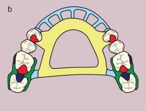 Şekil 11.33. b) Metal framework design.