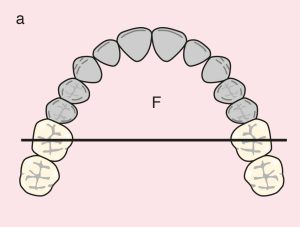 Figure 11.34. a) Cl IV: Diametric fulcrum line passing through the terminal abutments of teeth 16 and 26.