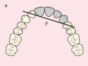 Figure 11.35. a) Cl IV: Diagonal fulcrum line passing through the terminal abutments of teeth 12 and 24.