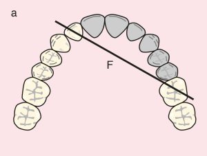 Figure 11.36. a) Cl IV: Diagonal fulcrum line passing through the terminal abutments of teeth 12 and 26.