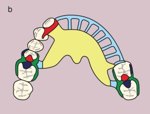 Figure 11.36. b) Metal framework design.