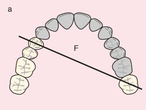 Figure 11.37. a) Cl IV: Diagonal fulcrum line passing through the terminal abutments of teeth 14 and 27.