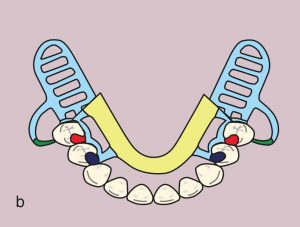Figure 11.38. b) Metal framework design.