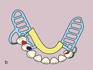 Figure 11.39. b) Metal framework design.