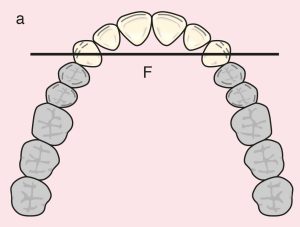 Figure 11.3. a) Cl I: The diametric fulcrum axis passing through the terminal abutments 13 and 23.