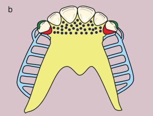b) Metal framework design (Dotted area on the U-plate: Ruga support; indirect retention)