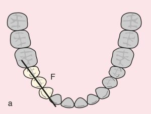 Case 11.40. a) Cl I: Asymmetric fulcrum line passing through the terminal abutments of teeth 35 and 45.