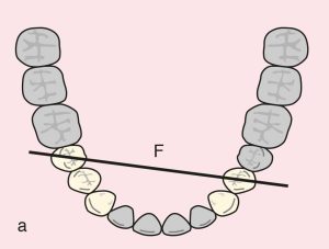 Figure 11.41. a) Cl I Mod 1: Diagonal fulcrum line passing through the terminal abutments of teeth 34 and 45.