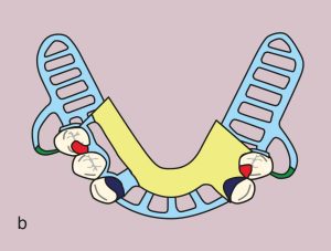 Figure 11.41. b) Metal framework design.