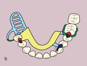 Figure 11.42. b) Metal framework design.