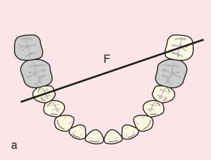 Figure 11.43. a) Cl II Mod 1: Diagonal fulcrum line passing through the terminal abutments of teeth 45 and 37.