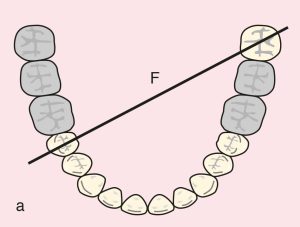 Figure 11.44. a) Cl II Mod 1: Diagonal fulcrum line passing through the terminal abutments of teeth 45 and 38.