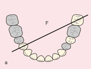 Figure 11.45. a) Cl II Mod 2: Diagonal fulcrum line passing through the terminal abutments of teeth 45 and 38.
