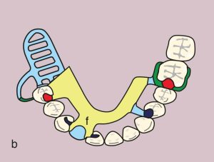 Figure 11.46. b) Metal framework design.