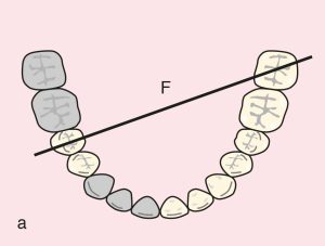 Figure 11.47. a) Cl II Mod 1: Diagonal fulcrum line passing through the terminal abutments of teeth 45 and 37.