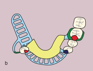 Figure 11.48.b) Metal framework design.