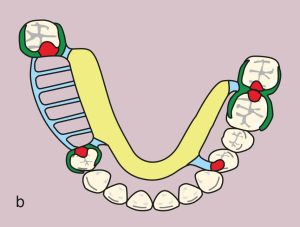Figure 11.49. b) Metal framework design.